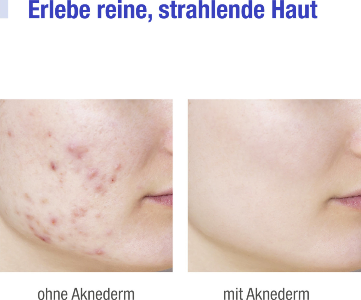 Bild 2 von Aknederm Creme zur Behandlung von Hautunreinheiten