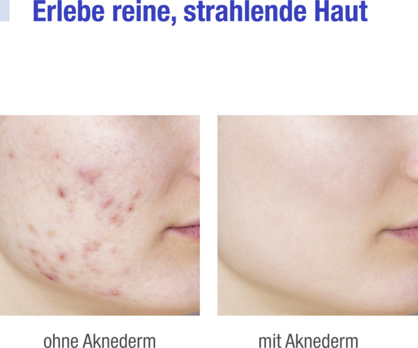 Bild 2 von Aknederm Reinigungsschaum gegen Hautunreinheiten