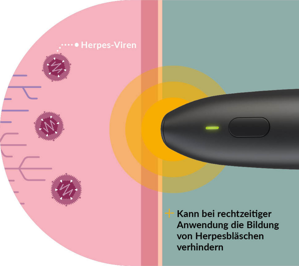 Bild 3 von Herpotherm Lippen-Herpes Wärmestift