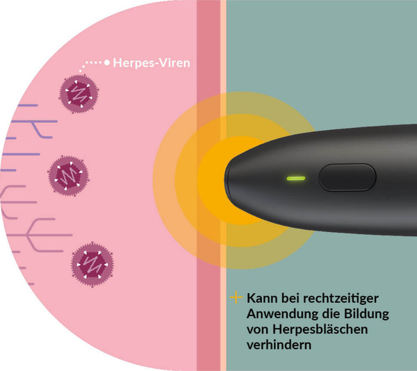 Bild 3 von Herpotherm Lippen-Herpes Wärmestift