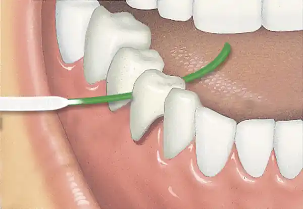 Bild 4 von GUM® ACCESS FLOSS Zahnseide mit Einfädelhilfe für 50 Anwendungen