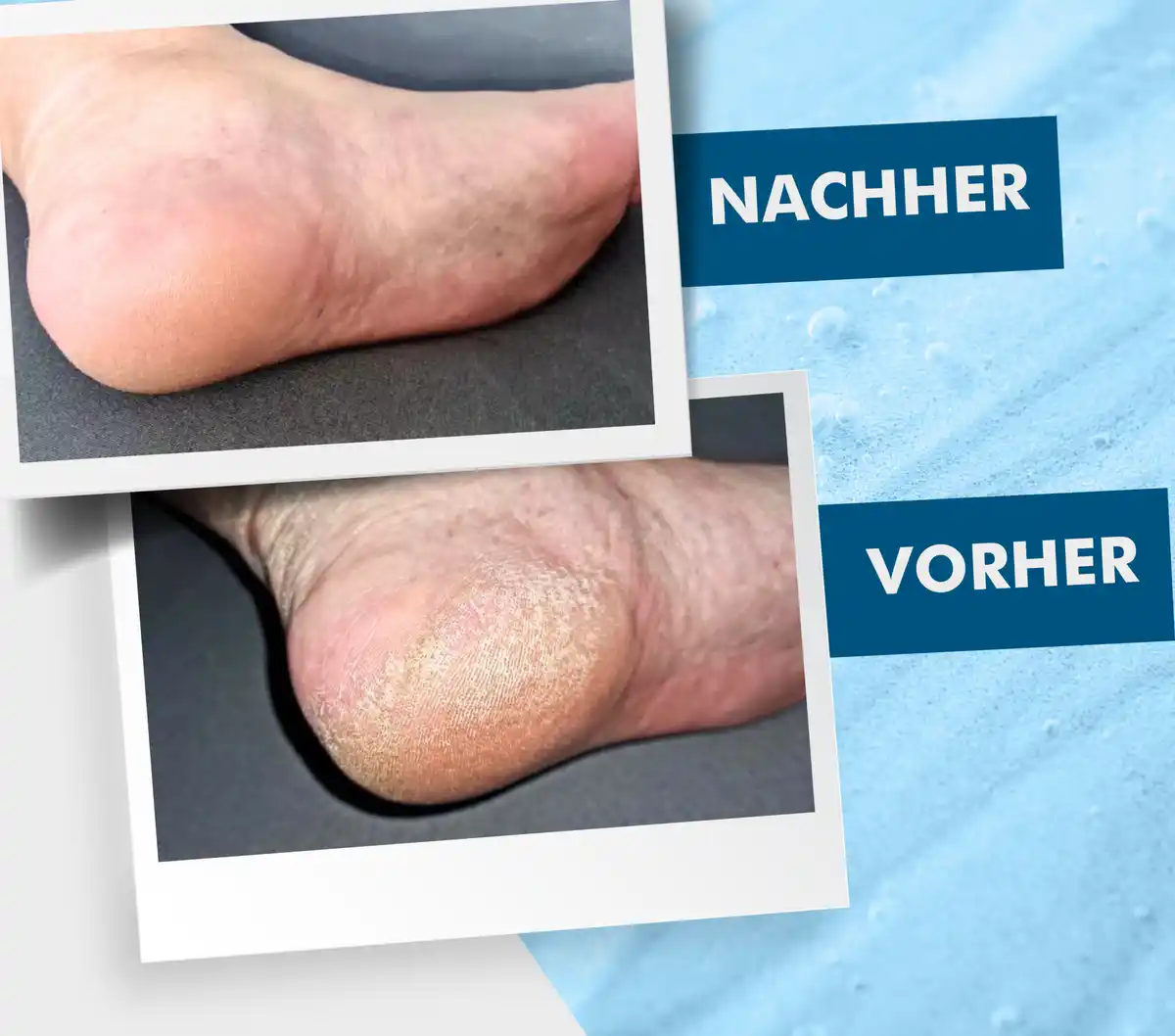 Bild 4 von Lopalmed Hornhaut- & Nagelhautentferner, 200 ml